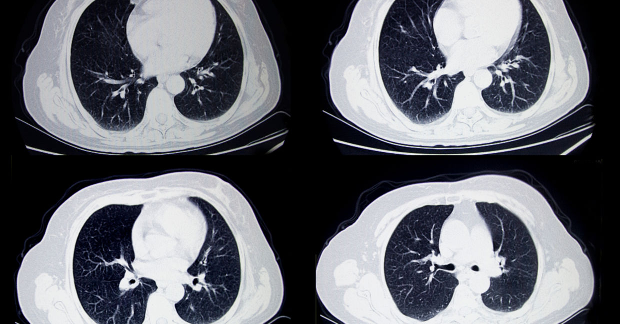 A CT scan of a lung A CT scan of a lung