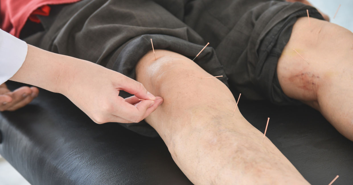 Healing acupuncture for relief from knee and leg pain. Healing acupuncture for relief from knee and leg pain.