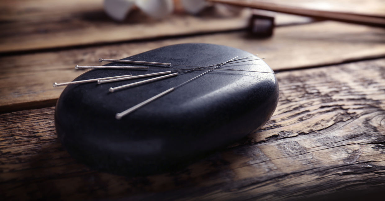Acupuncture needles could help with allergy relief. Acupuncture needles could help with allergy relief.